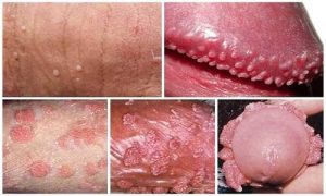 ngứa dương vật