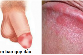 dau-hieu-viem-bao-quy-dau-o-nam-gioi