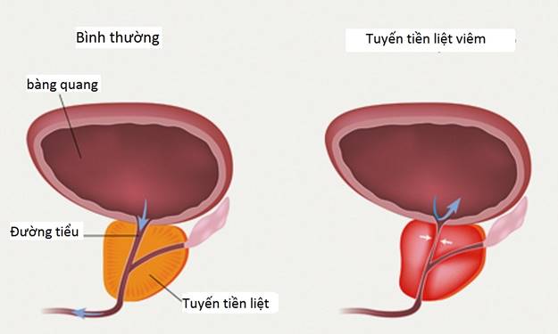 tiểu ra máu