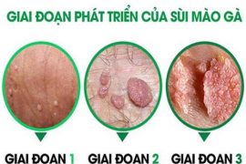 dau-hieu-trieu-chung-mac-benh-sui-mao-ga